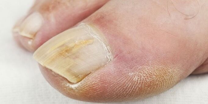 Síntomas de fungo das unhas dos pés