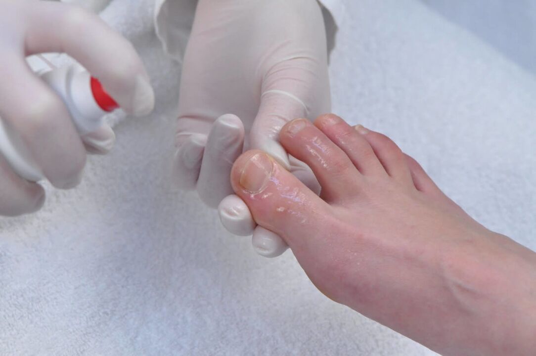 Spray para tratar fungos nas unhas