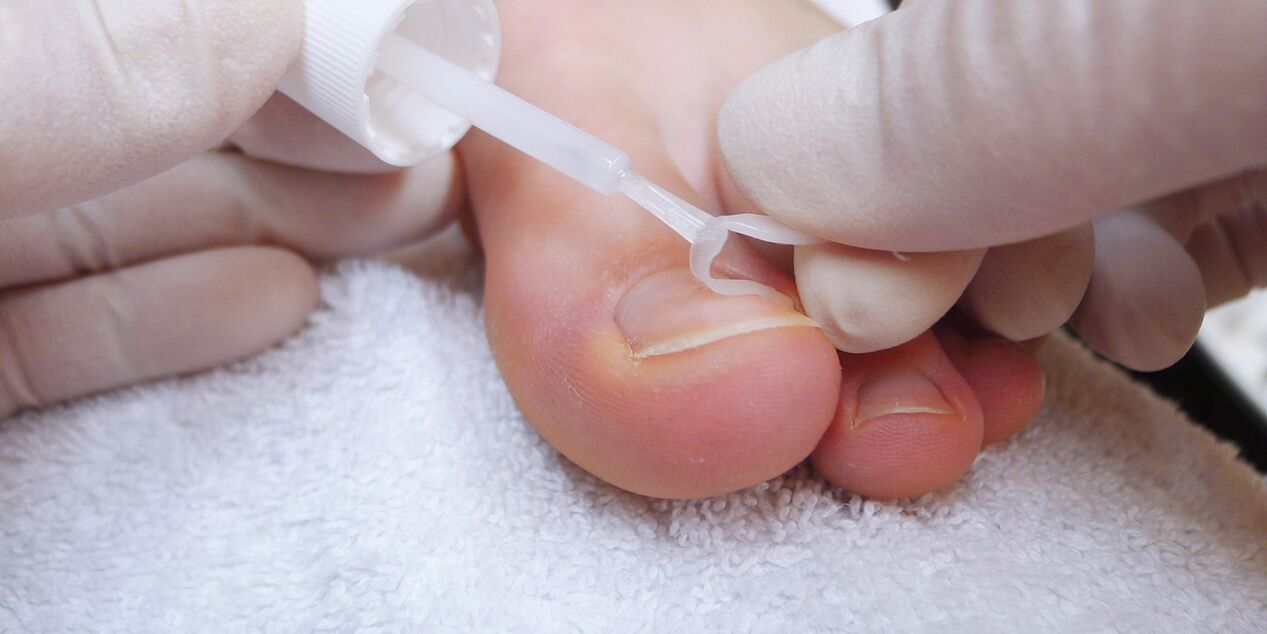 verniz médico contra fungos nas unhas