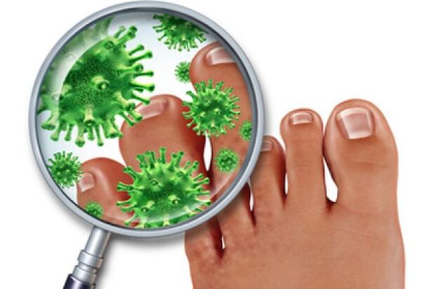 Infección fúngica nas unhas dos pés