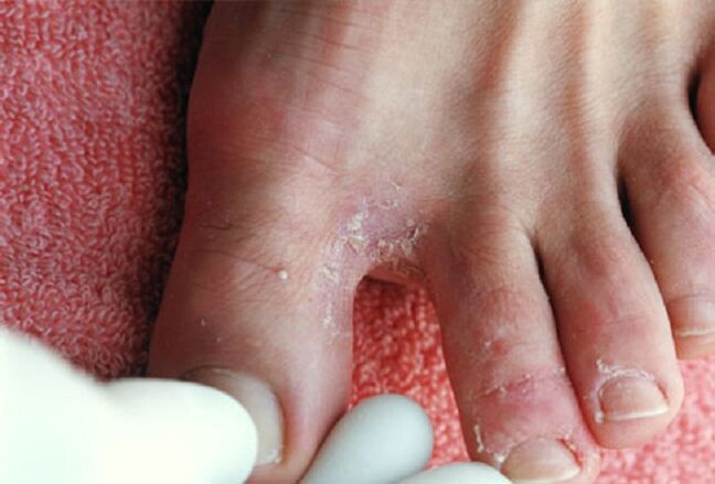 Manifestacións dun fungo intertrixinoso entre os dedos dos pés