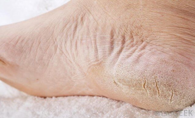 Os pés secos son un sinal de infección por fungos