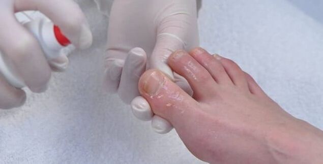 Fungo das uñas