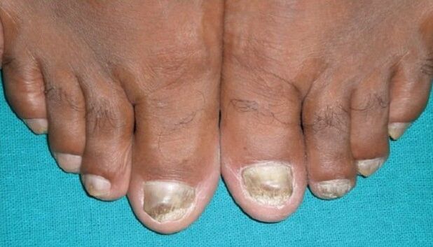 Cogomelo nas uñas