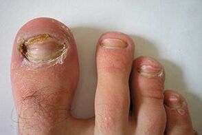 Cogomelo nas uñas