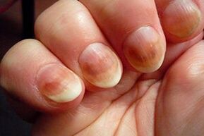 Fungo das uñas