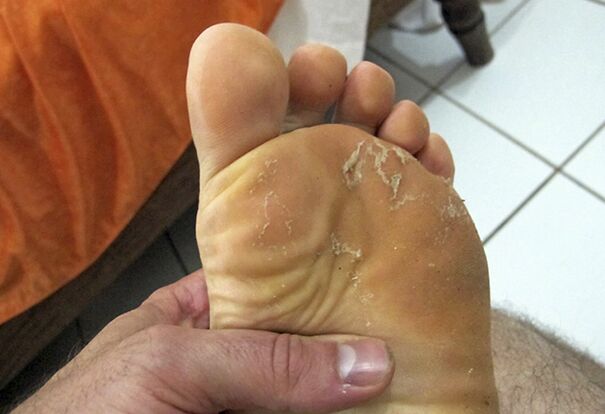 Cogomelo na pel das pernas