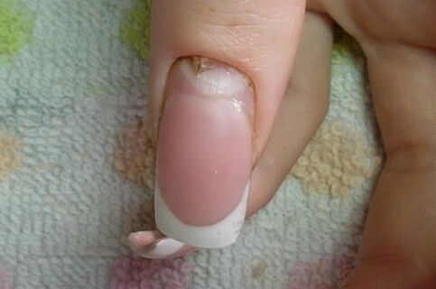 Síntomas de fungo nas unhas