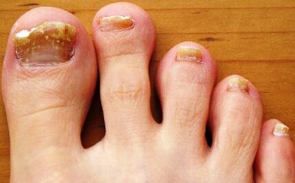 Unhas dos pés afectadas por fungos