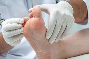 O médico examina os pés para detectar infeccións por fungos nos dedos