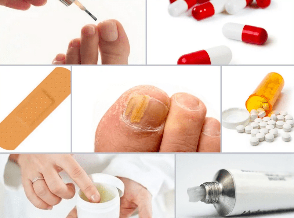 medicamentos sistémicos para o fungo das unhas